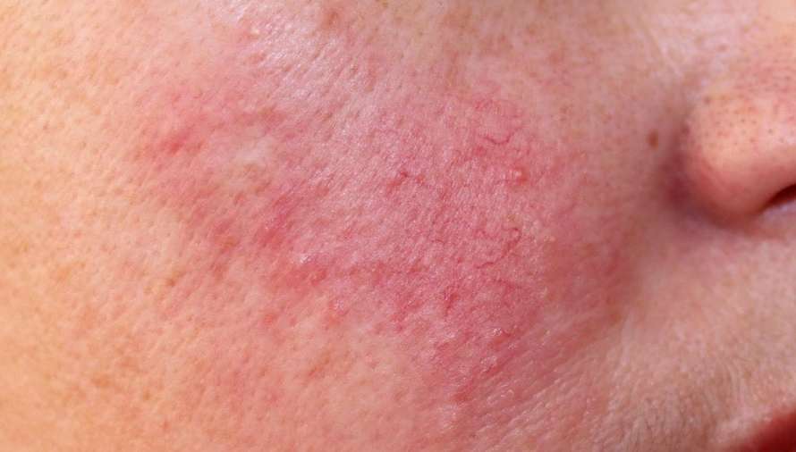 Sérum anticouperose : l&rsquo;huile de CBD comme remède ?