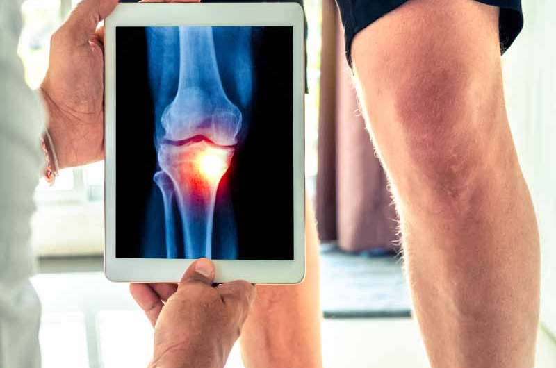 Le CBD peut-il vraiment soulager l&rsquo;arthrite et l&rsquo;arthrose ?